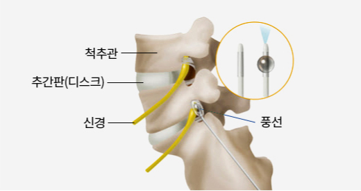 척추 압박골절